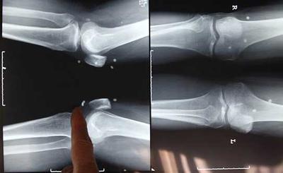 Pearls embedded in man's leg